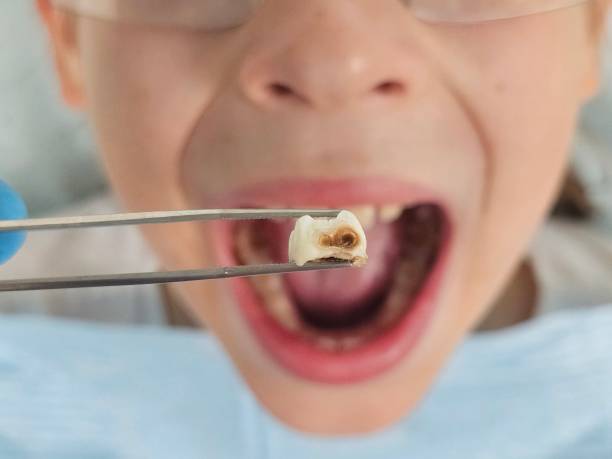 Best Emergency Wisdom Tooth Extraction in Winchester, CA